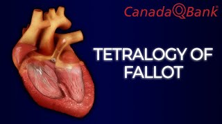 Tetralogy of Fallot [upl. by Latsyrc]