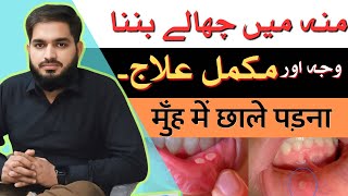 Moun Main Chalon Ka Ilaj  Munh Mein Chhale Kyon Hote Hain  Mouth Ulcer Treatment In UrduHindi [upl. by Asabi925]