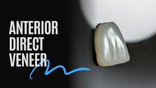 Anterior Direct veneer [upl. by Fairbanks967]