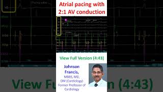 Atrial pacing with 21 AV conduction during electrophysiology EP study [upl. by Notecnirp194]