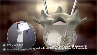 Bone Cement Procedure  Spine Animation [upl. by Hoang]