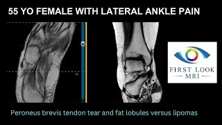 Peroneus brevis tendon tear and fatty lobules in foot [upl. by Anny]