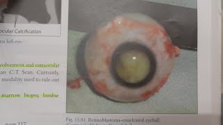 Retinoblastoma  EYE [upl. by Arataj]