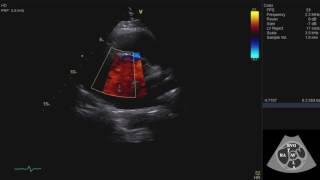 Echocardiography Essentials Mastering the parasternal short axis PSAX view of the aortic valve [upl. by Berrie773]