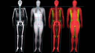¿Qué es la Desintometría Ósea [upl. by Anayek]
