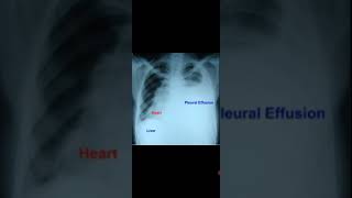 Left Sided Pleural Effusion with Dextroposition of HeartAwerenes of All [upl. by Beichner]