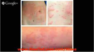 Urticaria Pictures  Protocols For Soothing Acute Urticaria  Urticaria Pictures [upl. by Brote847]