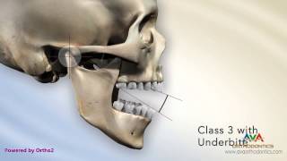 Malocclusion  Underbite or Crossbite Secondary to Short Maxillary Height [upl. by Halilahk]