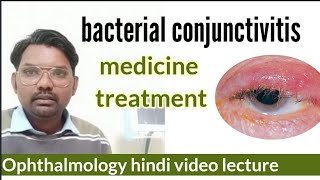 bacterial conjunctivitis  medicine treatment  conjunctivitis in eye  ophthalmology hindi [upl. by Elocel]