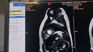 mri Cardiac analysis post processing video uploaded [upl. by Witte]