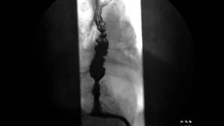 Esophageal Dysmotility with large Sliding Hiatal Hernia [upl. by Ko541]