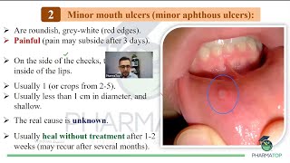 محاضرة تقرحات الفم Minor Aphthous Ulcers [upl. by Epul305]