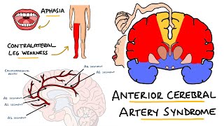 Anterior Cerebral Artery Stroke Syndrome  ACA Stroke Syndrome  Stroke Syndromes [upl. by Tallula]