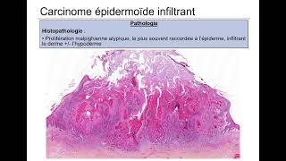 Tumeurs épidermiques II [upl. by Sorenson]