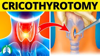 Cricothyrotomy Medical Definition  Quick Explainer Video [upl. by Der]