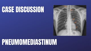 Case Discussion  Pneumomediastinum [upl. by Ran]