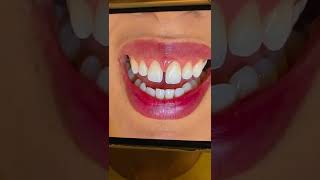 Fechamento de Diastema em Resina Composta pela Dra Daiane Souza [upl. by Ycrep294]