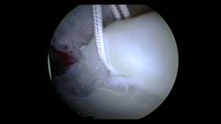 Hip Arthroscopy Labral Repair Surgery  Repair Torn Hip Labrum  Dr David J King [upl. by Aitetel851]