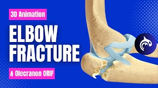 Elbow Olecranon Fracture and Fixation  3D Animation [upl. by December]