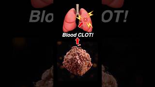 Doctor Explains PULMONARY EMBOLISM 🫁💥 [upl. by Molohs]