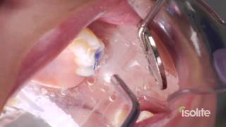 Dental Sealants with Isolite [upl. by Tav336]