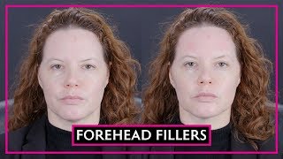 Dermal Fillers For Your Forehead [upl. by Huberman698]