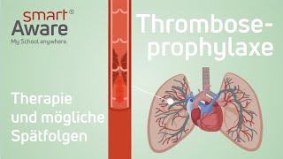 Thromboseprophylaxe Therapie und mögliche Spätfolgen  Fachfortbildungen in der Pflege  smartAware [upl. by Rianon]