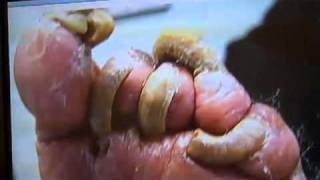 What is a fungal nail infectionMinnesota Podiatrist Explains wwwinnovativefootcarecom [upl. by Terzas]