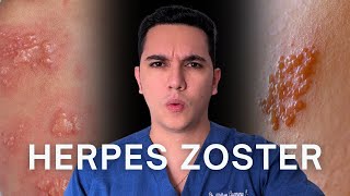 Culebrilla Herpes zoster ¿Qué sucede si se une la cabeza con la cola  Dr William Guerrero [upl. by Enneirda]