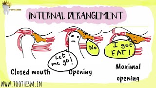 INTERNAL DERANGEMENT Anterior Disk Displacement  Temporomandibular Joint [upl. by Quickman756]