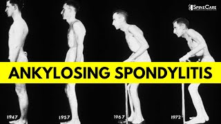 What is Ankylosing Spondylitis Causes Symptoms and Diagnosis EXPLAINED [upl. by Eissoj920]