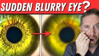 Sudden Blurry Vision In One Eye 5 Causes [upl. by Jairia]