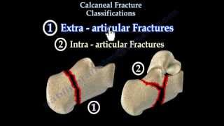 Calcaneal Fracture Classifications  Everything You Need To Know  Dr Nabil Ebraheim [upl. by Rebmyt]