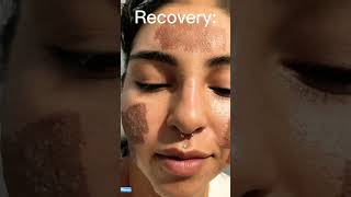 We Treated Her Acne in just One Day 😱skincare beauty shorts laser [upl. by Odradlig]