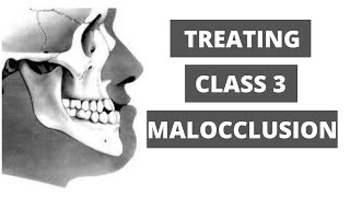 Management of Class 3 Malocclusion Orthodontics [upl. by Xenos]