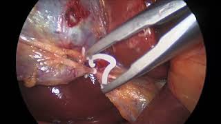 cholecystectomy postWeight loss surgery [upl. by Saber]