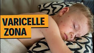 VARICELLE  ZONA  1 seul virus  2 maladies [upl. by Min]