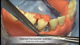 Periodontal Regenerative Emdogain Surgery with Papilla preservation  Flap design and suturing [upl. by Eirod]