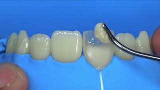 Step By Step Direct Composite Restoration Central Incisor [upl. by Yrotciv]