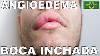 ANGIOEDEMA  BOCA INCHADA  TIREOIDITE HASHIMOTO [upl. by Hiamerej255]