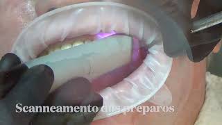 Provisorio sobre dente [upl. by Domineca]