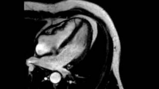 Constrictive pericarditis fourchamber ECGgated cine SSFP MR [upl. by Eulaliah]