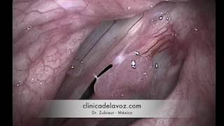 Vocal Fold Papillomas  Papilomas de cuerdas vocales [upl. by Sicnarf]