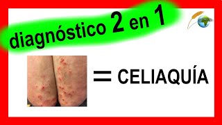 Dermatitis Herpetiforme DIAGNOSTICO amp DIAGNOSTICO DIFERENCIAL  fotos Inmunofluorescencia directa [upl. by Sande]