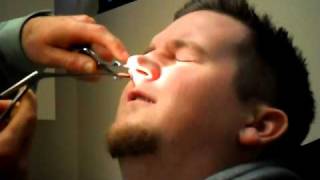 Septoplasty  Turbinate Reduction Splint Removal [upl. by Odlo]