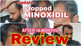 Reviewing the effect of minoxidil mintop 10 after 18 months from the day i stopped using itResul [upl. by Assiran]