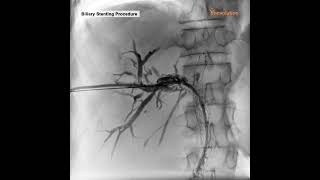 Biliary Stenting Procedure On Premier Elite Cath Lab [upl. by Nafri]