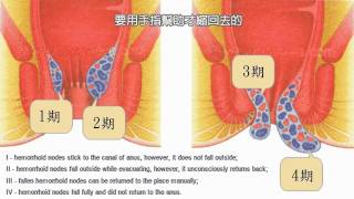 痔瘡甚麼情況下需要做手術 香港痔瘡中心 查詢31163836 [upl. by Anne-Marie]