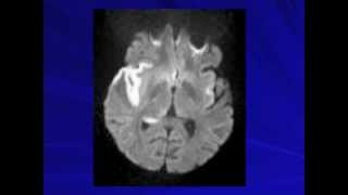 Aseptic Meningitis  Ana Velez MD [upl. by Esten]