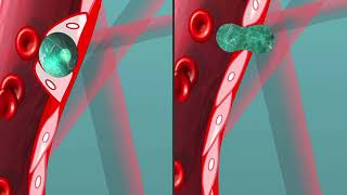 Animation of tumor cells extravasating through angiopellosis and diapedesis [upl. by Nochur202]